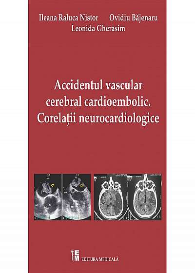 Accidentul vascular cerebral cardioembolic