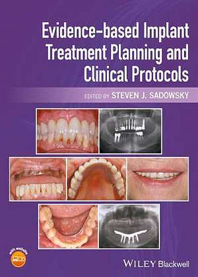 Evidence–based Implant Treatment Planning and Clinical Protocols