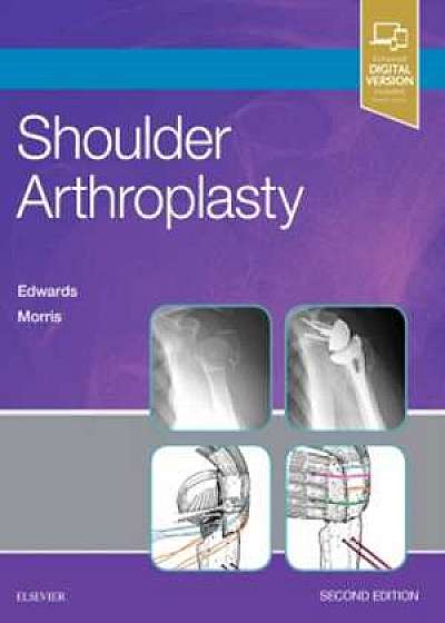 Shoulder Arthroplasty