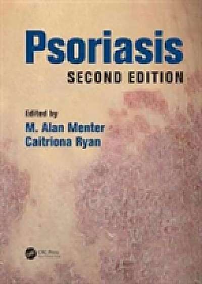 Coperta cărții Psoriasis, Second Edition