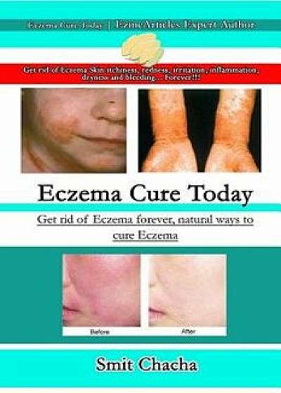 Eczema Cure Today - Get Rid of Eczema Forever Natural Ways to Cure Eczema, Paperback/Smit Chacha