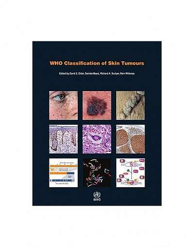Who Classification of Skin Tumours