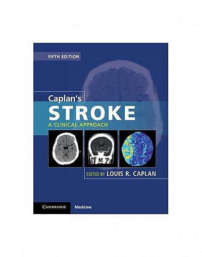 Caplan's Stroke: A Clinical Approach