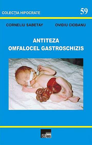 Antiteza omfalocel gastroschizis